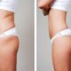 liposuction cost in Punjab