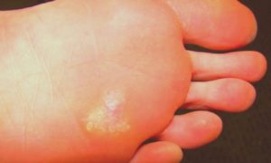 best foot doctor for plantar fasciitis in Houston