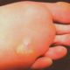 best foot doctor for plantar fasciitis in Houston