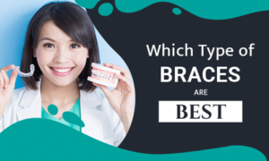 braces